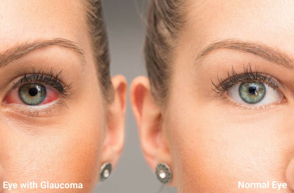 Glaucoma treatment